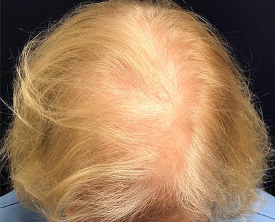 FUE Hair Restoration Before & After Gallery - Patient 327977 - Image 1