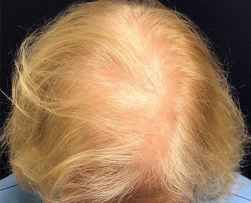 FUE Hair Restoration Before & After Gallery - Patient 327977 - Image 1