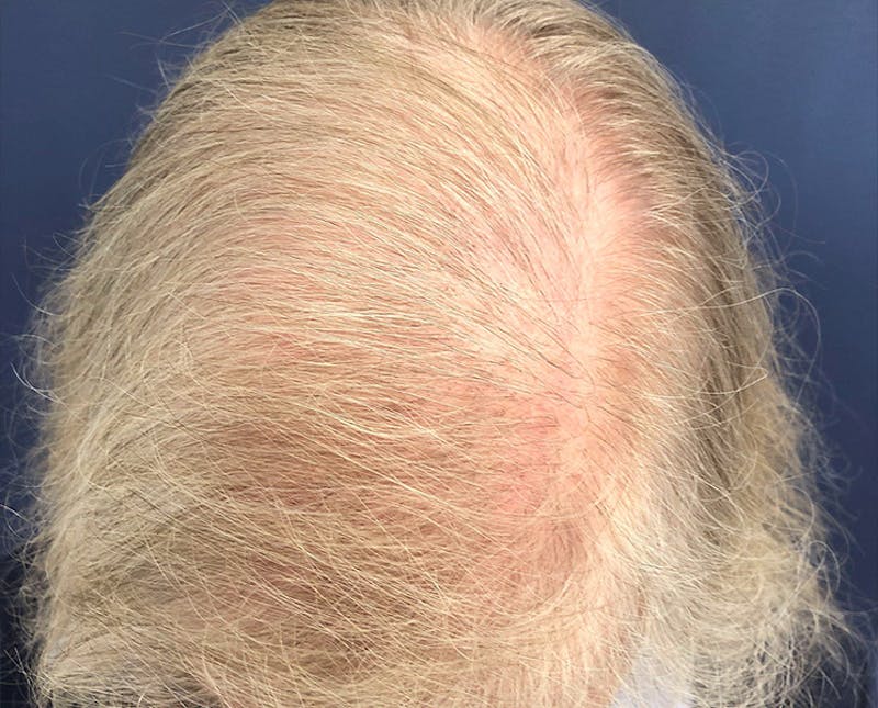 FUE Hair Restoration Before & After Gallery - Patient 327977 - Image 2