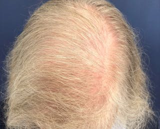FUE Hair Restoration Before & After Gallery - Patient 327977 - Image 2