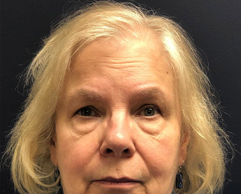 FUE Hair Restoration Before & After Gallery - Patient 327977 - Image 3