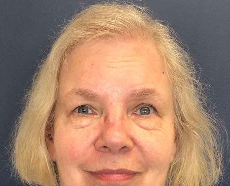 FUE Hair Restoration Before & After Gallery - Patient 327977 - Image 4