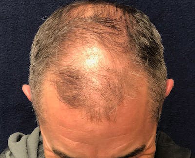 FUE Hair Restoration Before & After Gallery - Patient 221926 - Image 1