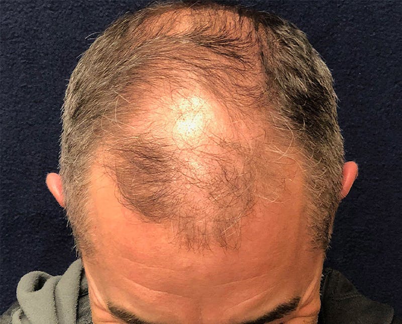 FUE Hair Restoration Before & After Gallery - Patient 221926 - Image 1