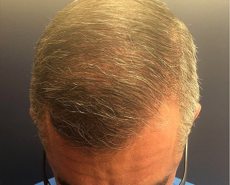 FUE Hair Restoration Before & After Gallery - Patient 221926 - Image 2