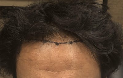 FUE Hair Restoration Before & After Gallery - Patient 396898 - Image 1