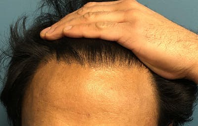 FUE Hair Restoration Before & After Gallery - Patient 396898 - Image 2
