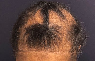 FUE Hair Restoration Before & After Gallery - Patient 283132 - Image 1