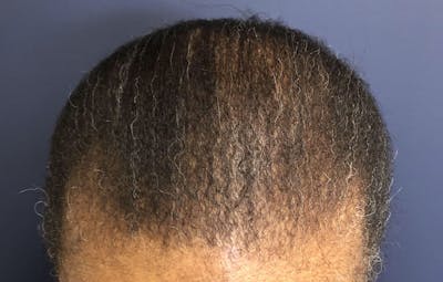 FUE Hair Restoration Before & After Gallery - Patient 283132 - Image 2