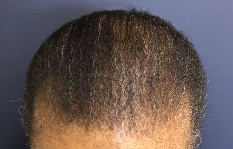 FUE Hair Restoration Before & After Gallery - Patient 283132 - Image 2