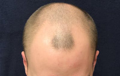 FUE Hair Restoration Before & After Gallery - Patient 405125 - Image 1