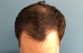 FUE Hair Restoration Before & After Gallery - Patient 405125 - Image 2