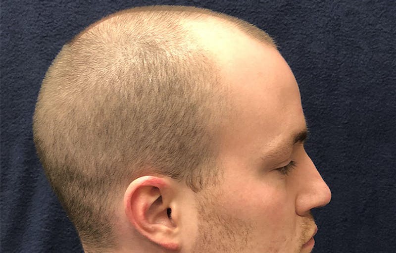 FUE Hair Restoration Before & After Gallery - Patient 405125 - Image 3