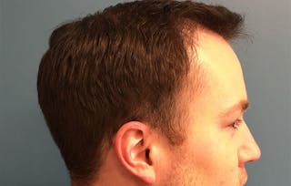 FUE Hair Restoration Before & After Gallery - Patient 405125 - Image 4