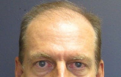 FUE Hair Restoration Before & After Gallery - Patient 356197 - Image 1