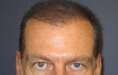 FUE Hair Restoration Before & After Gallery - Patient 356197 - Image 2