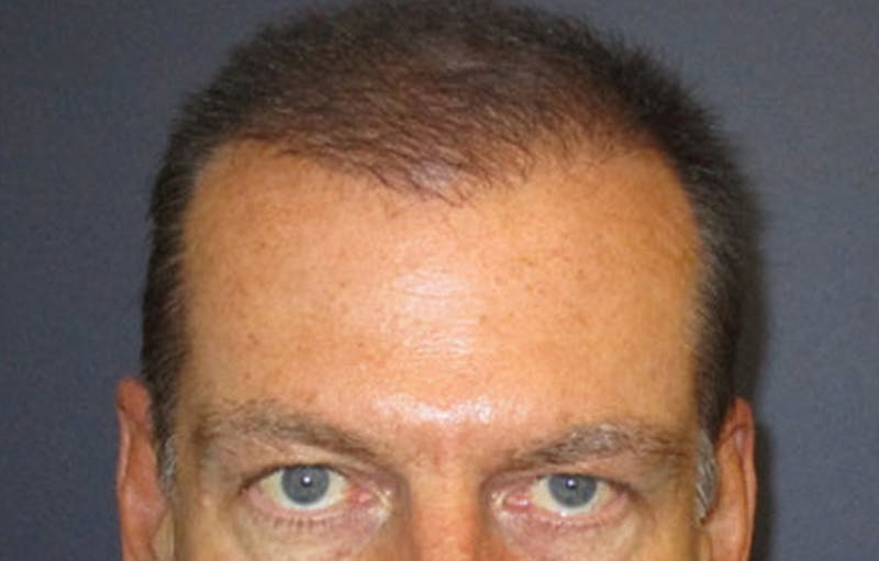 FUE Hair Restoration Before & After Gallery - Patient 356197 - Image 2