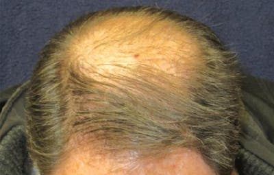 FUE Hair Restoration Before & After Gallery - Patient 348280 - Image 1