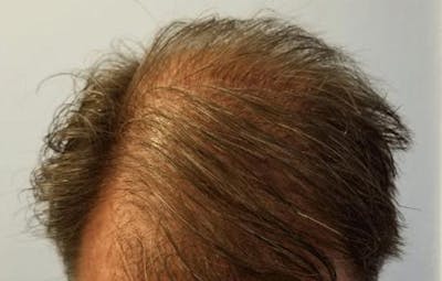 FUE Hair Restoration Before & After Gallery - Patient 348280 - Image 2