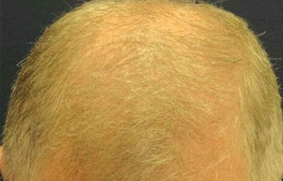 FUE Hair Restoration Before & After Gallery - Patient 380541 - Image 1