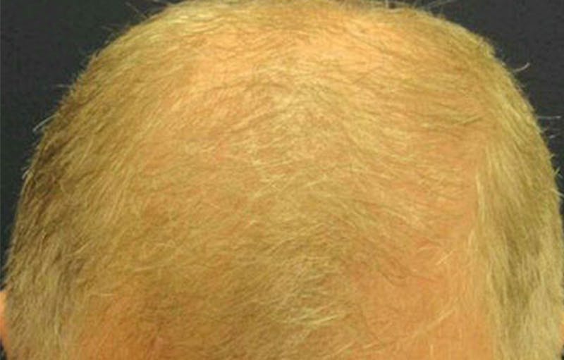 FUE Hair Restoration Before & After Gallery - Patient 380541 - Image 1