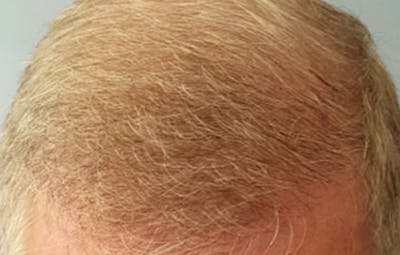 FUE Hair Restoration Before & After Gallery - Patient 380541 - Image 2