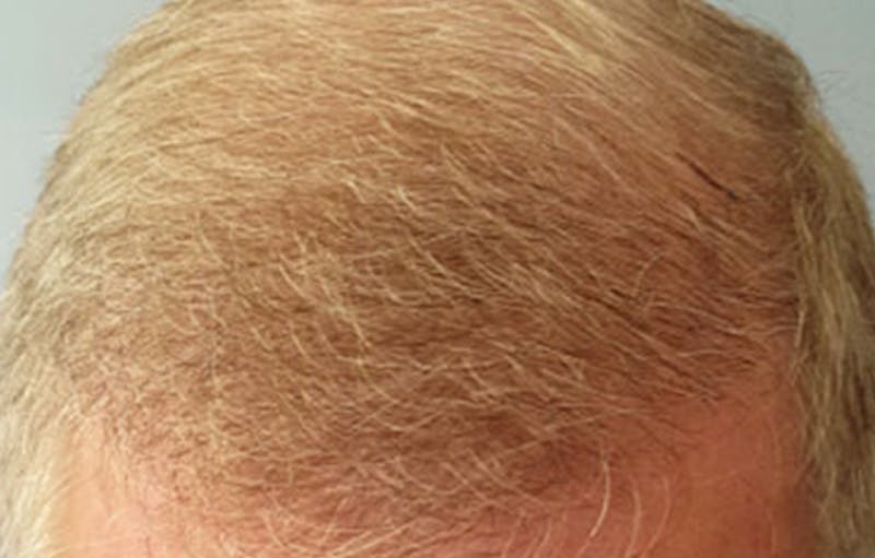 FUE Hair Restoration Before & After Gallery - Patient 380541 - Image 2