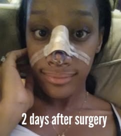 woman with nose bandage