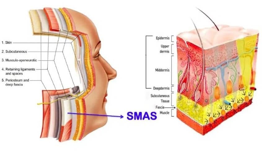 SMAS facelift infographic
