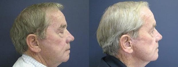 facelift results
