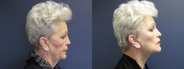 facelift results