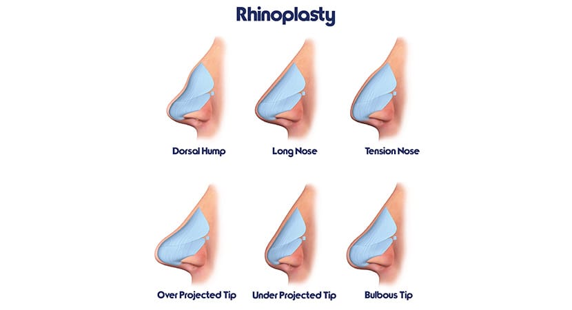 rhinoplasty infographic