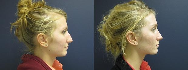 rhinoplasty patient