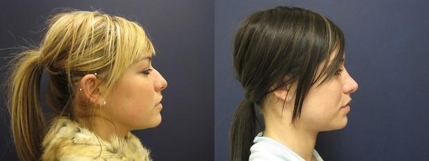 rhinoplasty patients