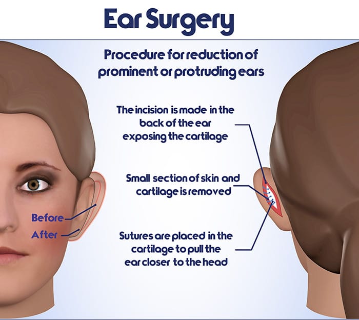 ear surgery infographic
