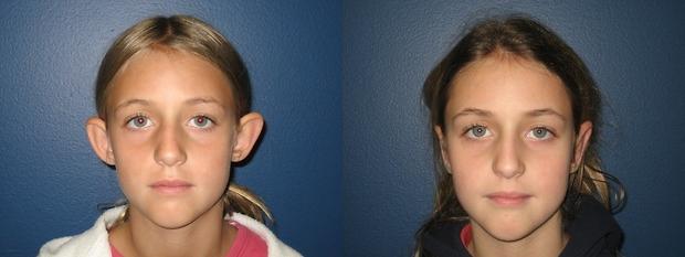 otoplasty patient