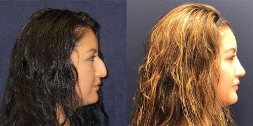 before and after