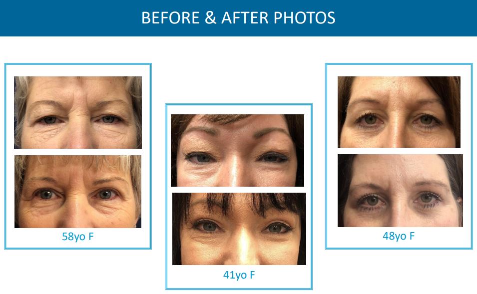 eyelid surgery results