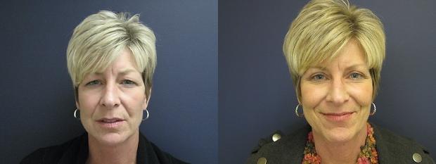 eyelid surgery patient