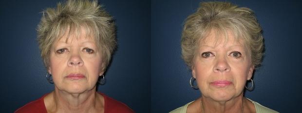 eyelid surgery patient