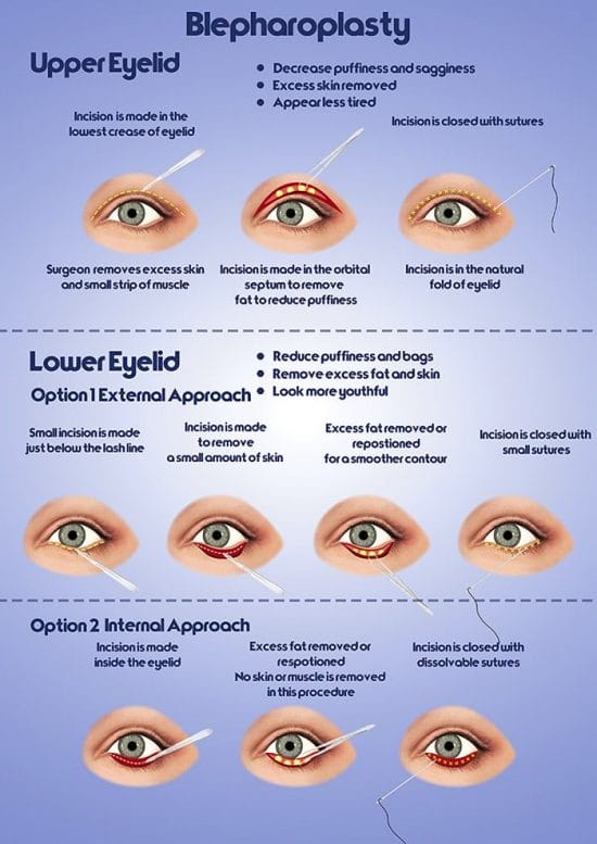 blepharoplasty infographic
