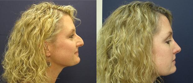 nasal hump reduction results