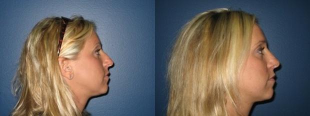 nasal hump reduction results
