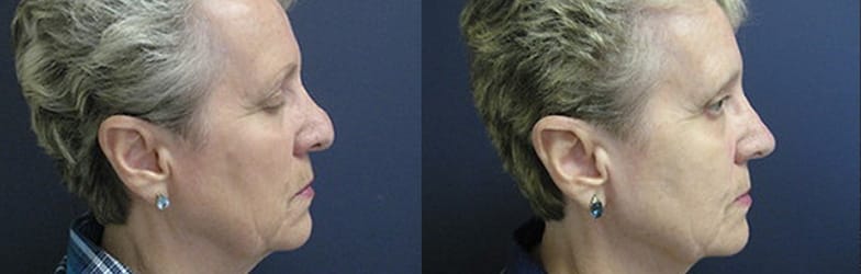 revision rhinoplasty patient