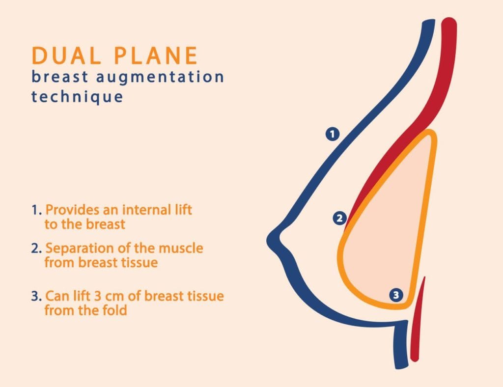 dual plane breast augmentation infographic