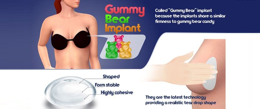 implant infographic