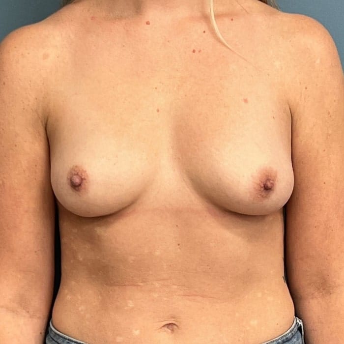 laser breast augmentation patient