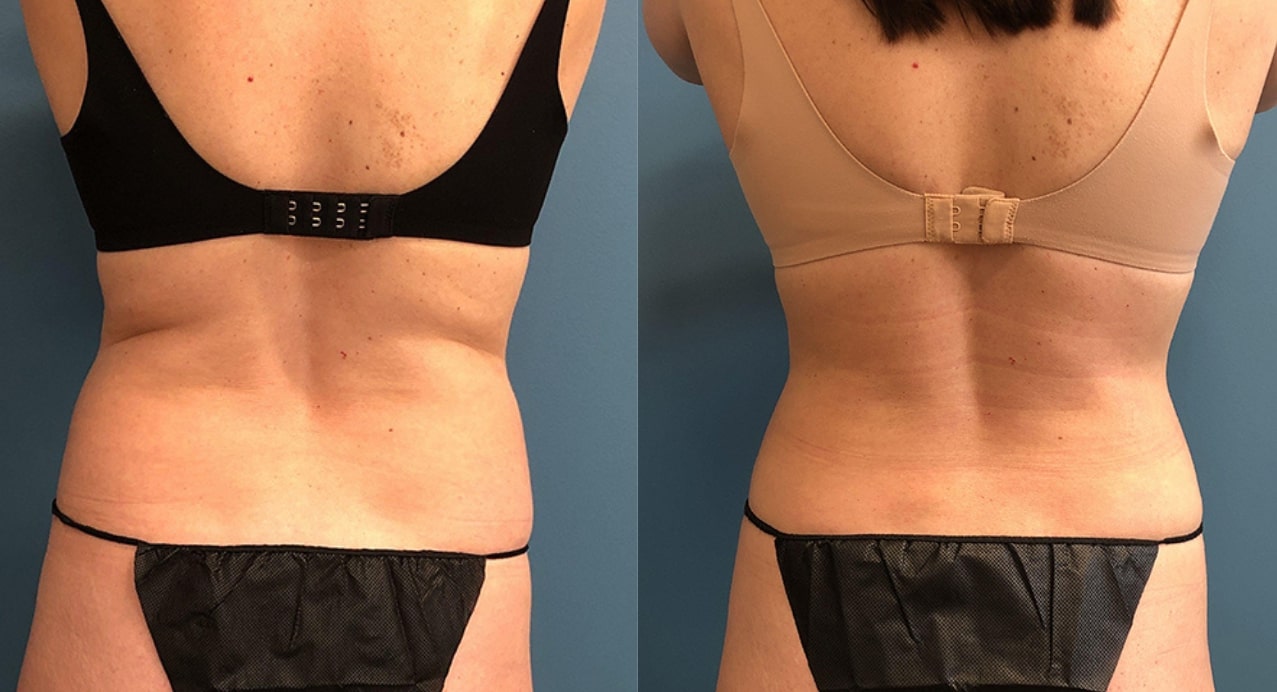 liposuction patient results
