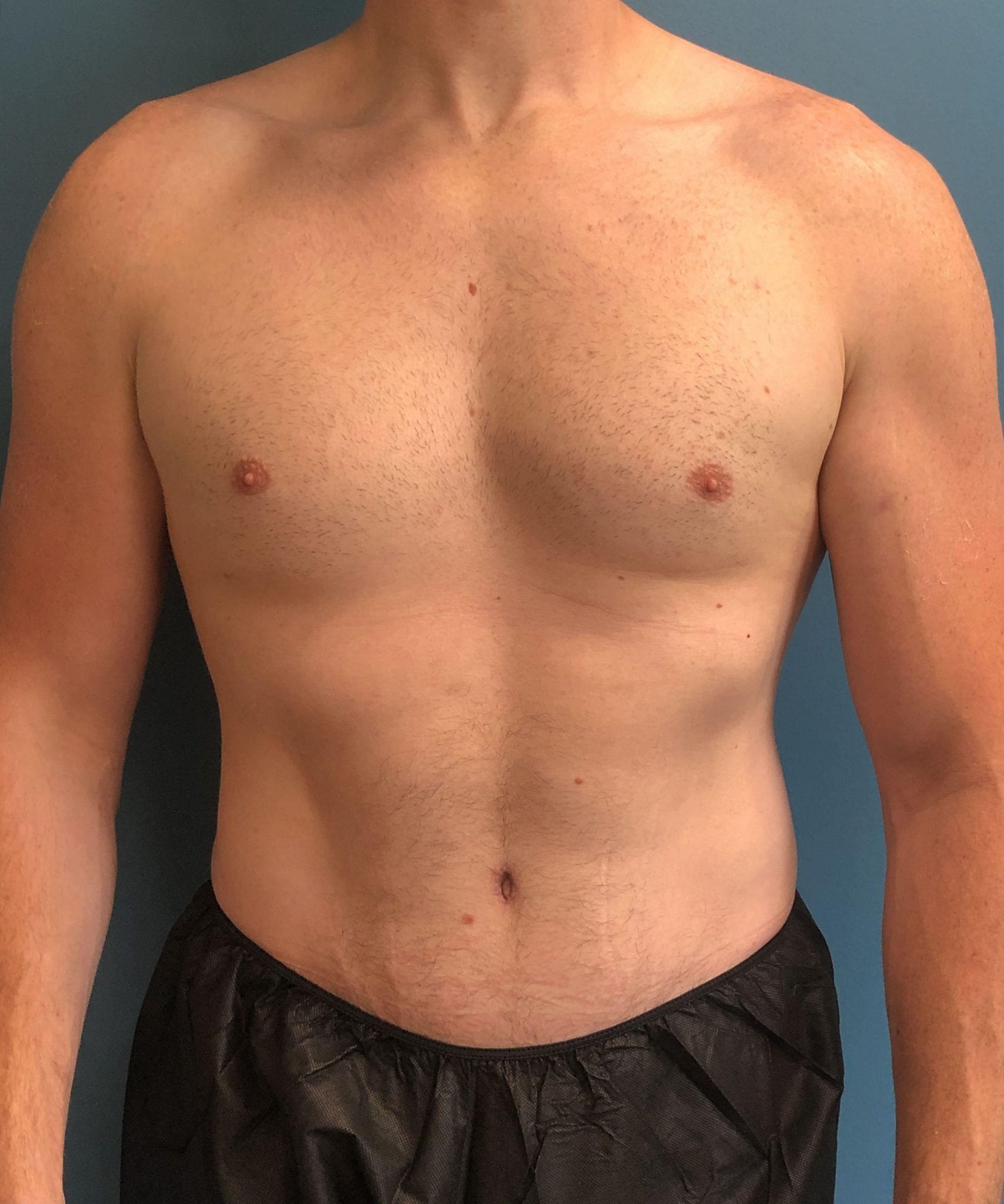 powertuck patient
