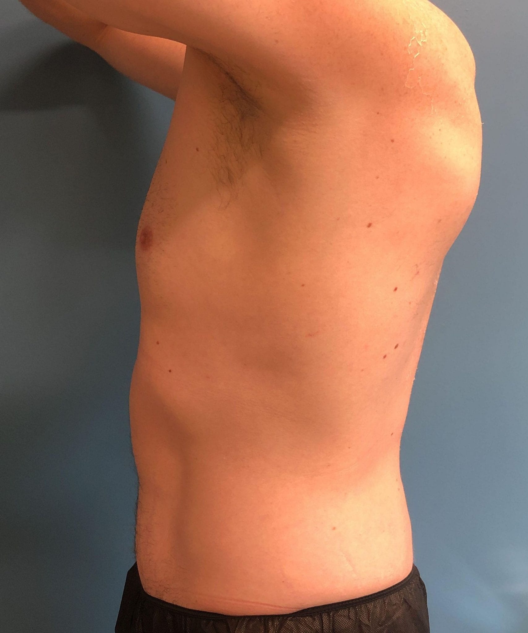 powertuck patient